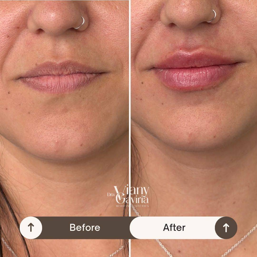 Antes y después de armonización labial