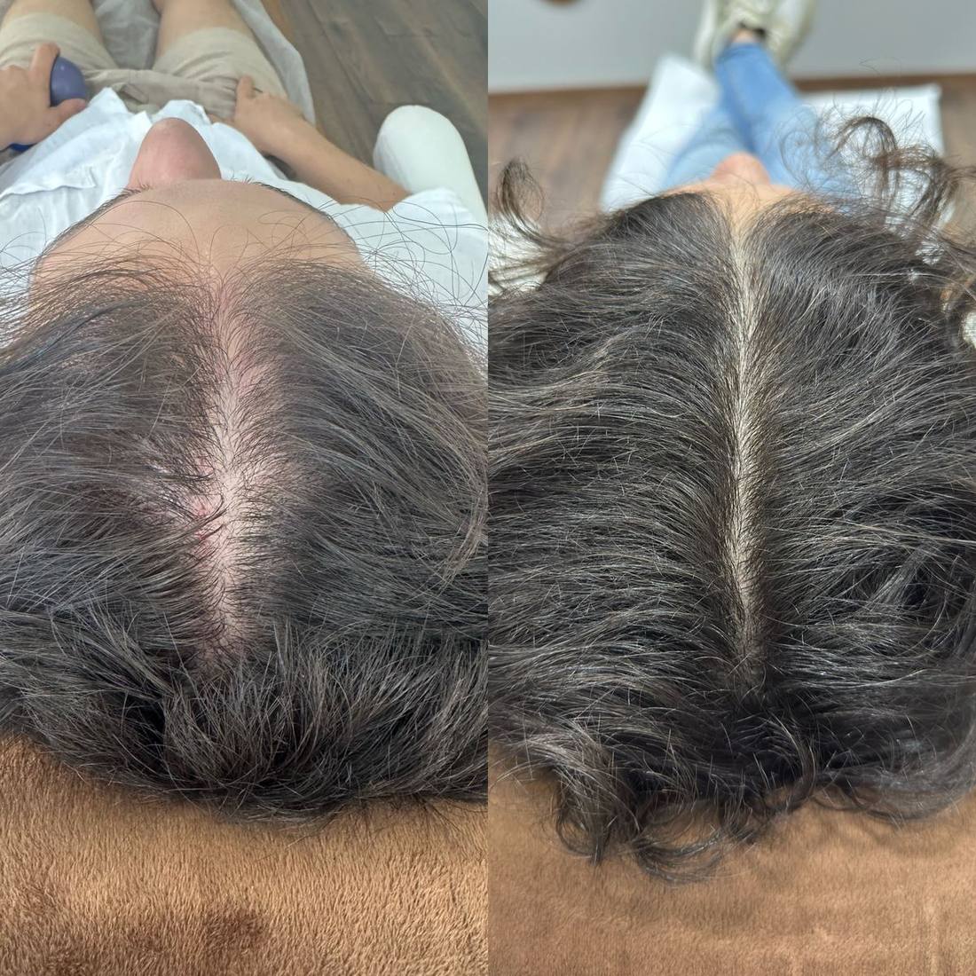 Antes y después de protocolo capilar, caso 2