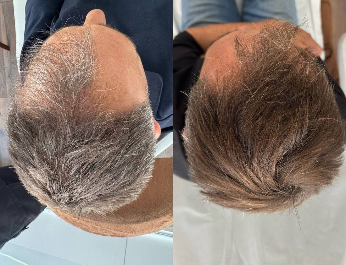 Antes y después de protocolo capilar, caso 3