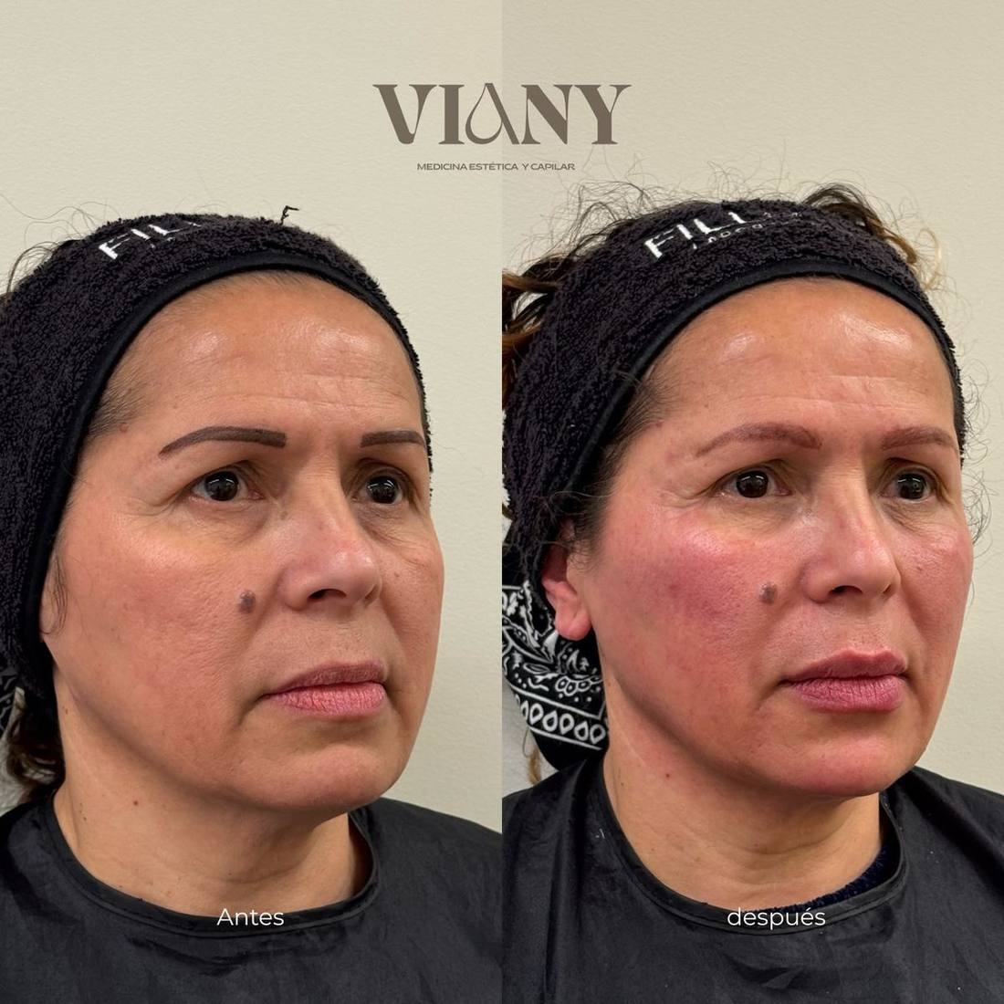 Antes y después de rejuvenecimiento facial