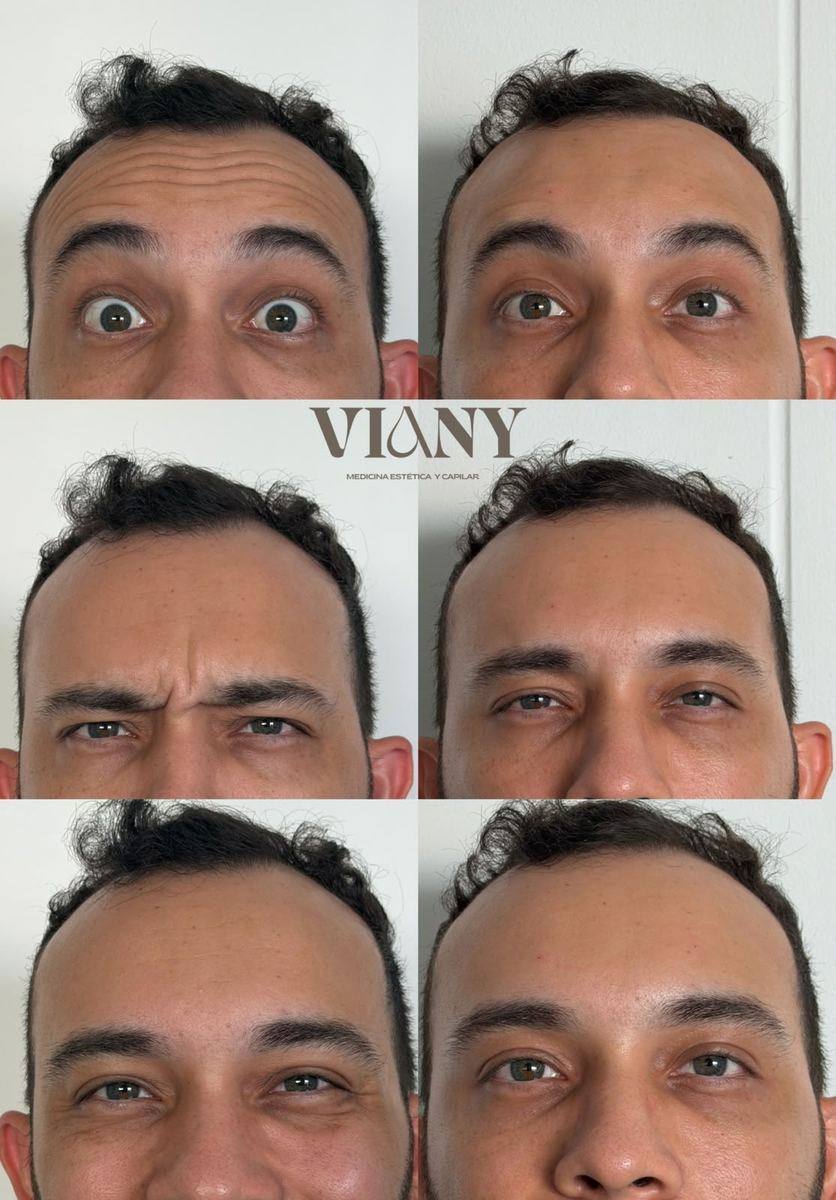 Antes y después de tratamiento de líneas de expresión